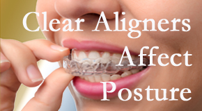 Clear aligners influence posture which Severna Park chiropractic helps.