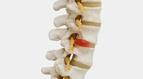 Severna Park chiropractic conservative care helps even giant disc herniations go away