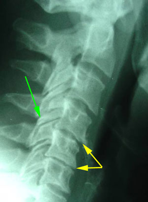 disc degeneration treated at Back And Neck Care Center