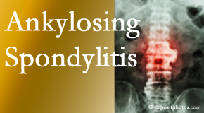 Ankylosing spondylitis is gently cared for by your Severna Park chiropractor.