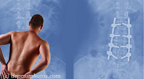 Severna Park chiropractic relief for back pain after back surgery