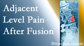 Back And Neck Care Center offers relieving care non-surgically to back pain patients experiencing adjacent level pain after spinal fusion surgery.